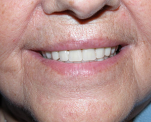 Replacement of Old Complete Denture